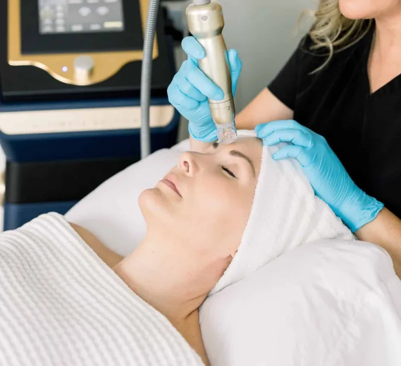 Microneedling treatment