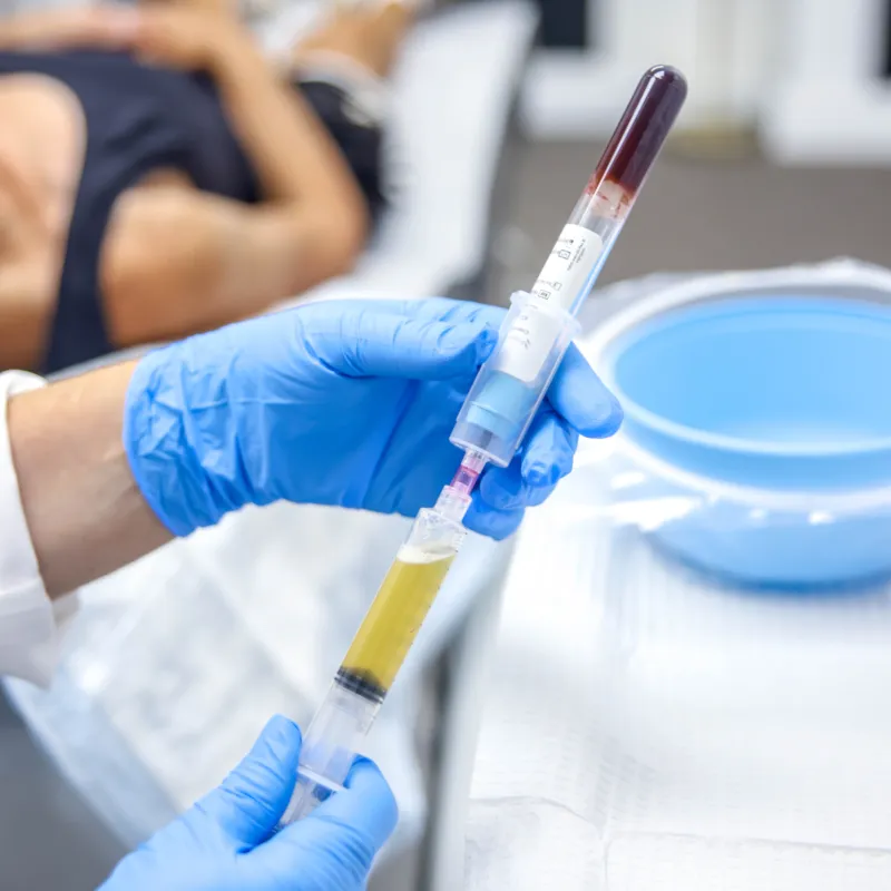 PRP preparation